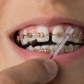 The Right Way to Use and Care for Braces and Supports