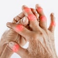 Understanding Arthritis: Symptoms and Diagnosis