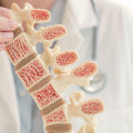 Understanding the Causes of Osteoporosis